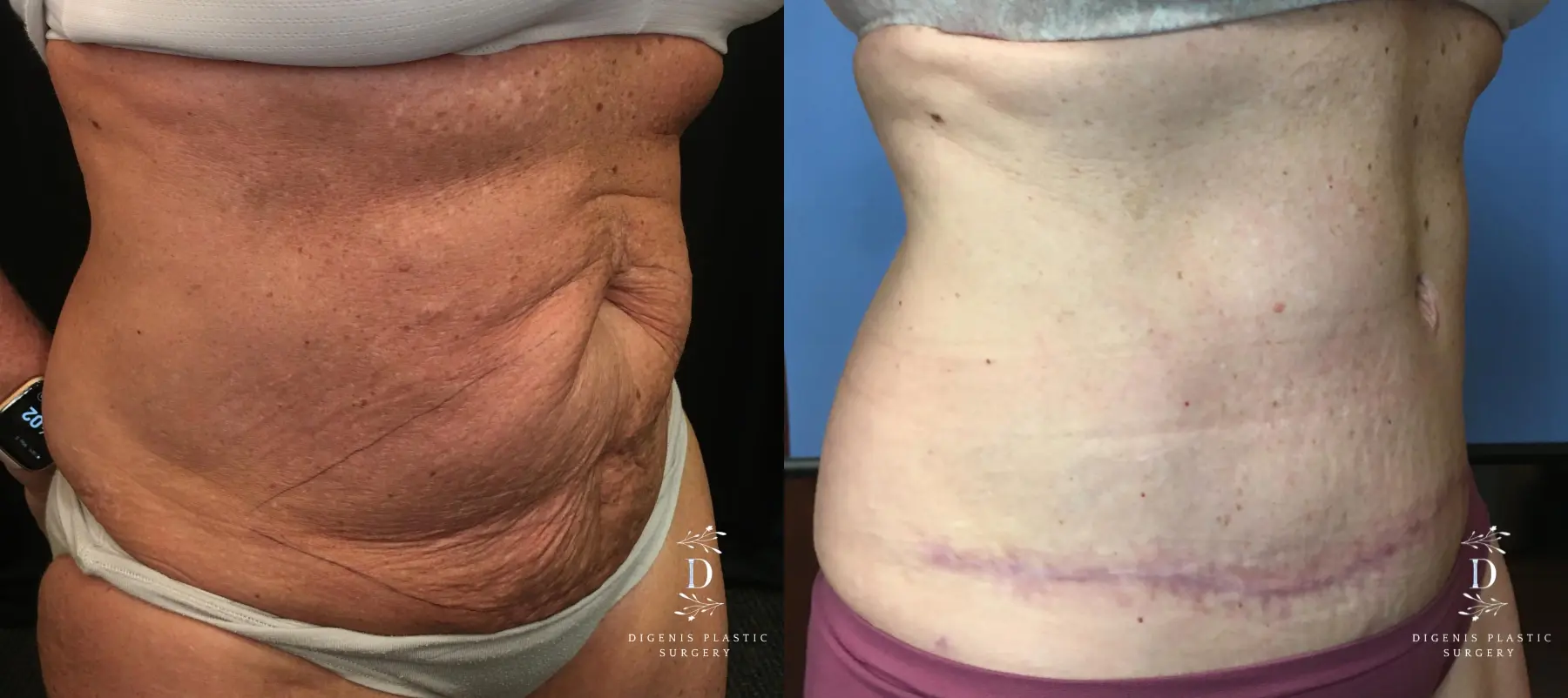 Abdominoplasty: Patient 12 - Before and After 2