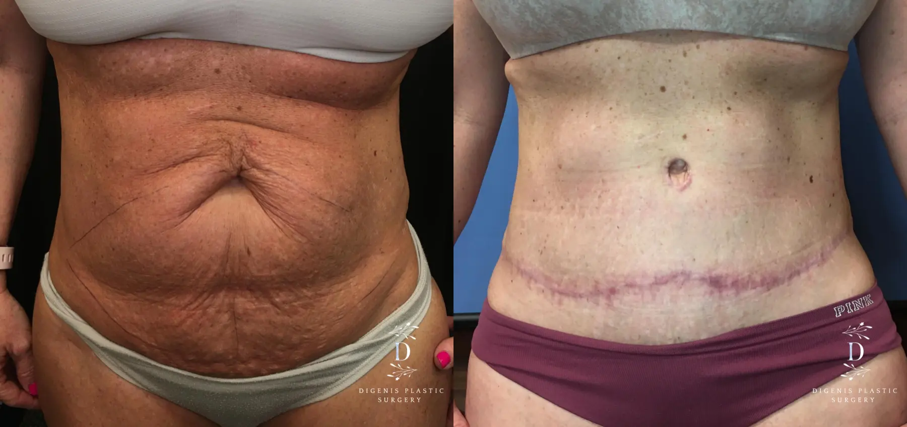 Abdominoplasty: Patient 12 - Before and After 1