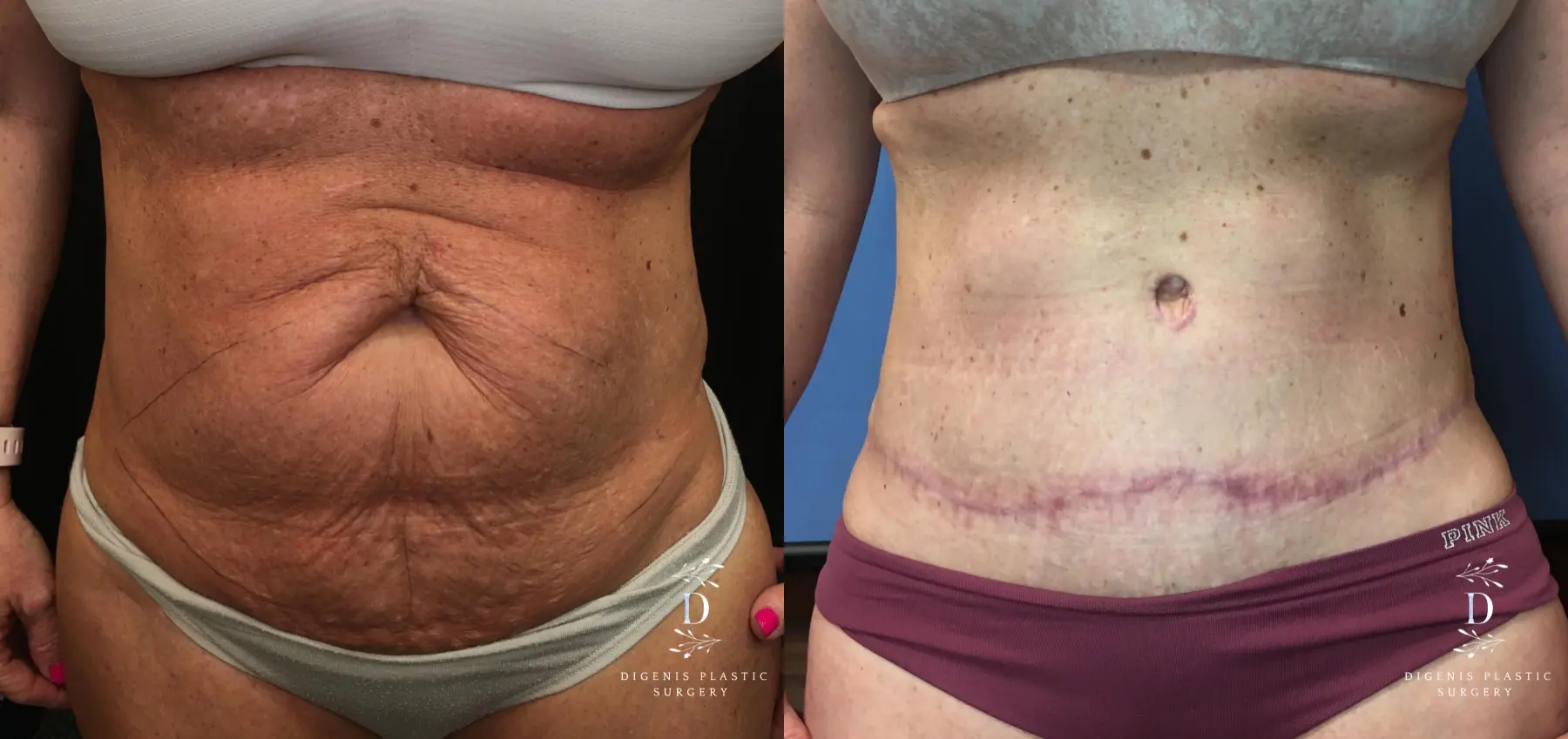 Abdominoplasty: Patient 13 - Before and After  