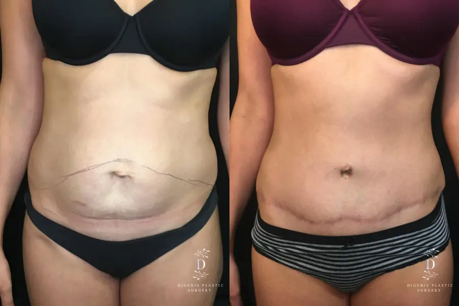 Abdominoplasty: Patient 10 - Before and After  