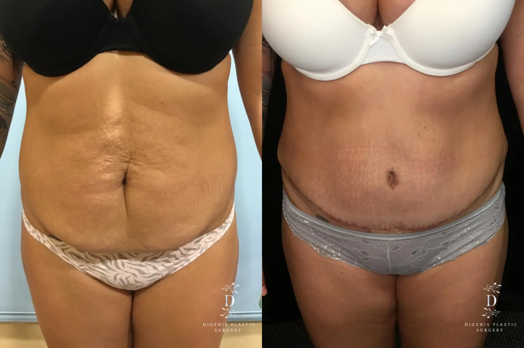 Abdominoplasty: Patient 7 - Before and After  