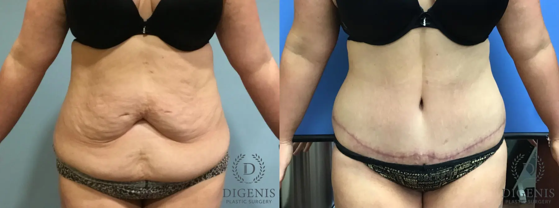 Abdominoplasty: Patient 6 - Before and After 1