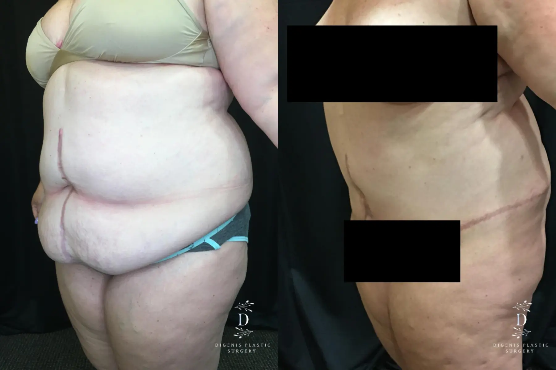 Abdominoplasty: Patient 14 - Before and After 4