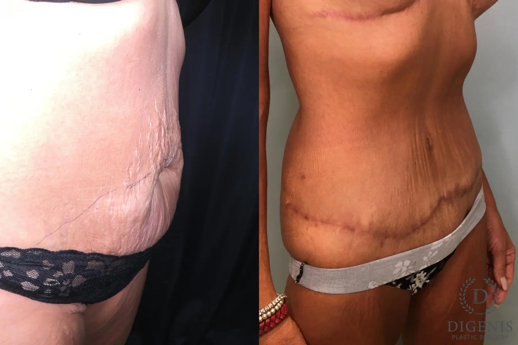 Abdominoplasty: Patient 20 - Before and After 4