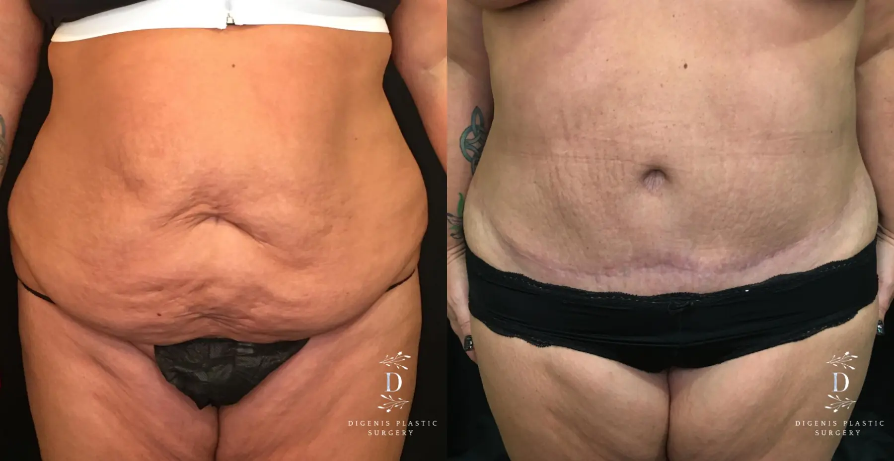 Abdominoplasty: Patient 9 - Before and After  