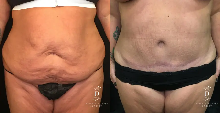 Abdominoplasty: Patient 7 - Before and After 1