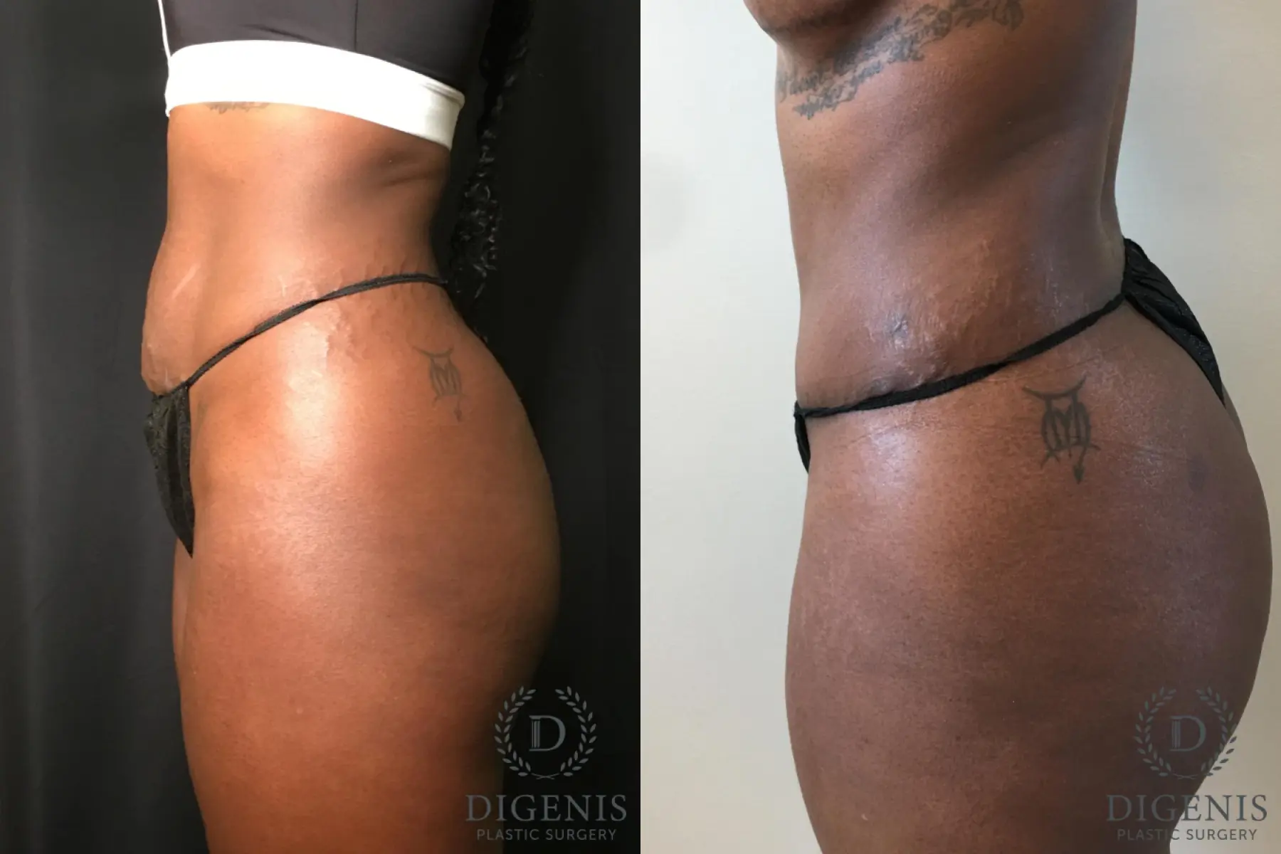 Abdominoplasty: Patient 18 - Before and After 5