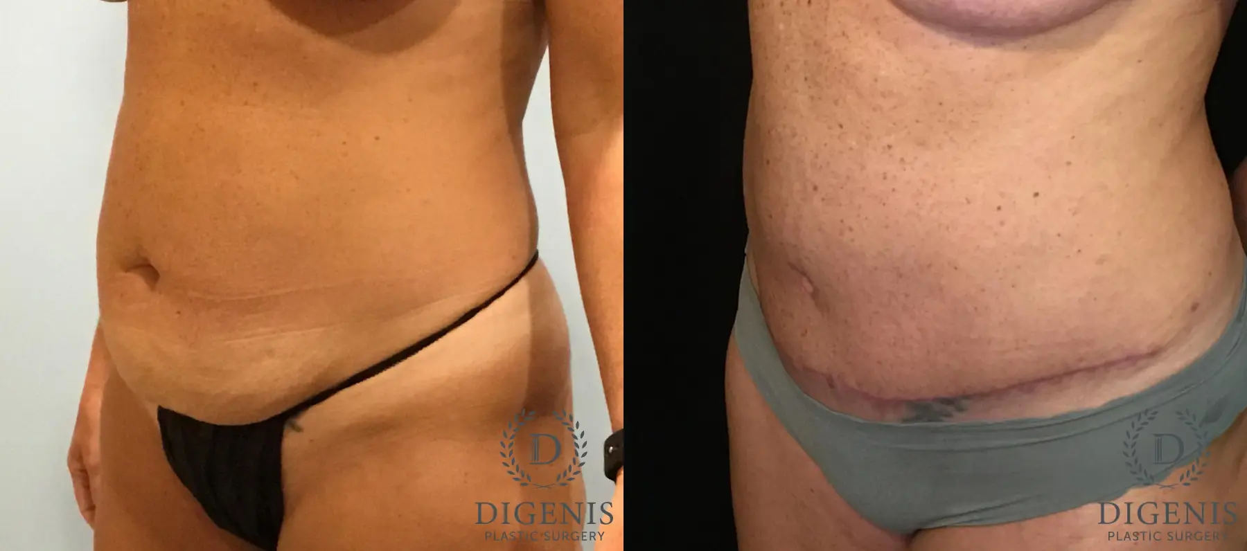 Abdominoplasty: Patient 4 - Before and After 4