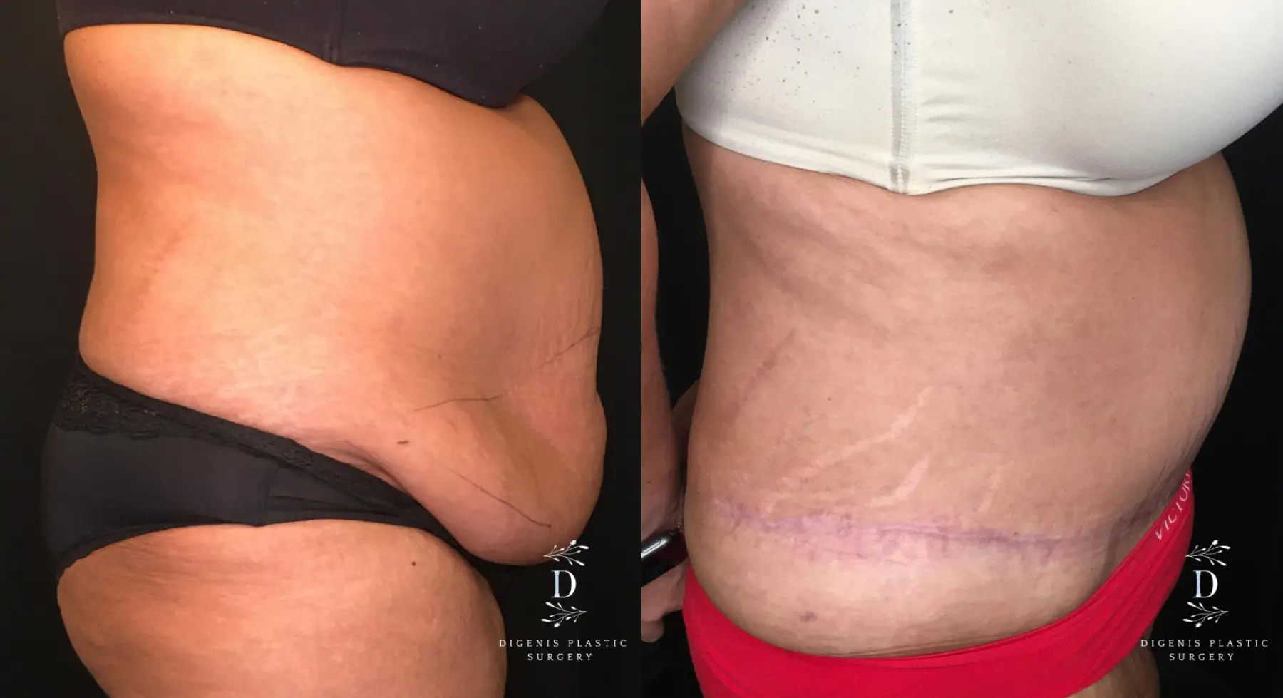 Abdominoplasty: Patient 13 - Before and After 3