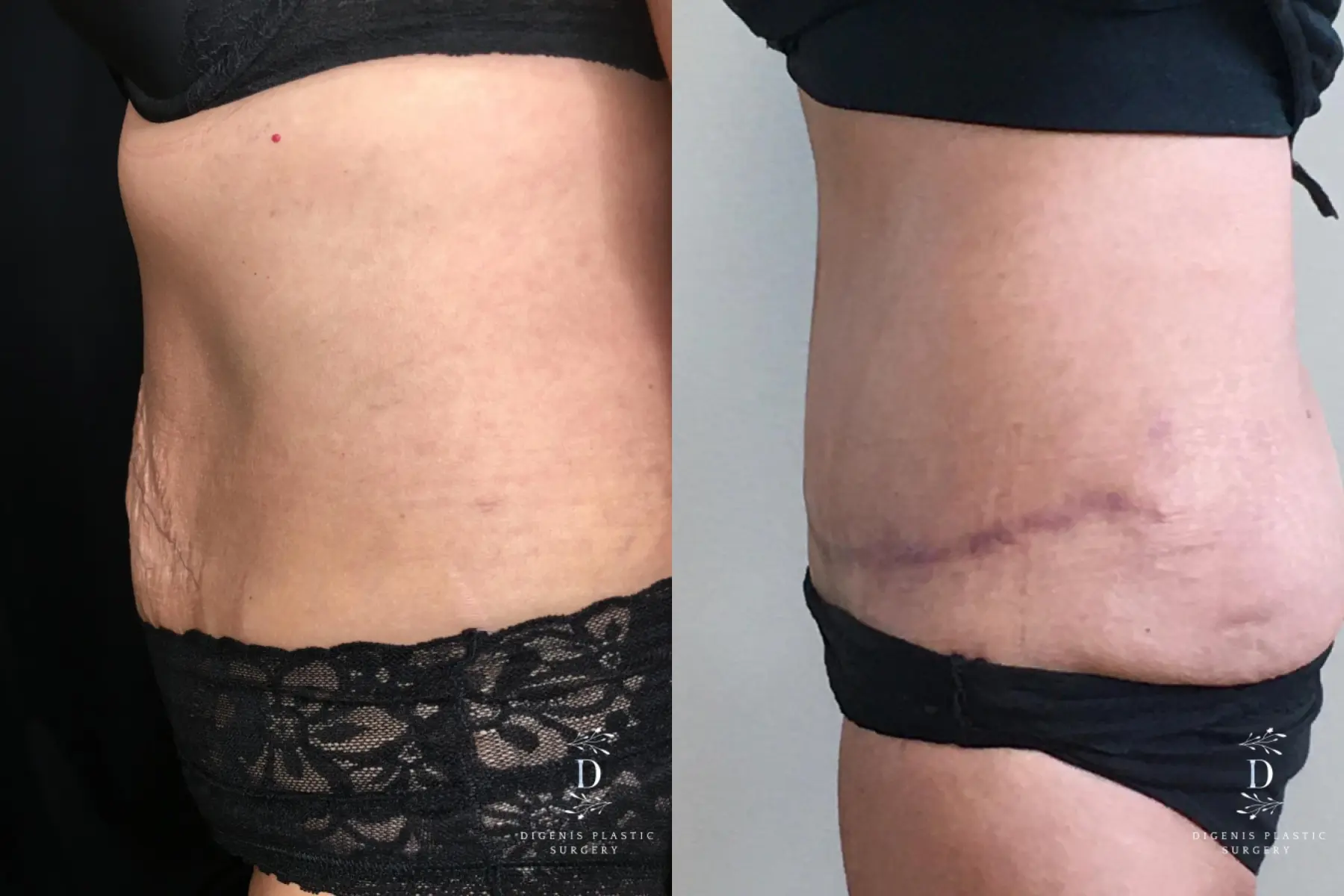Abdominoplasty: Patient 17 - Before and After 5