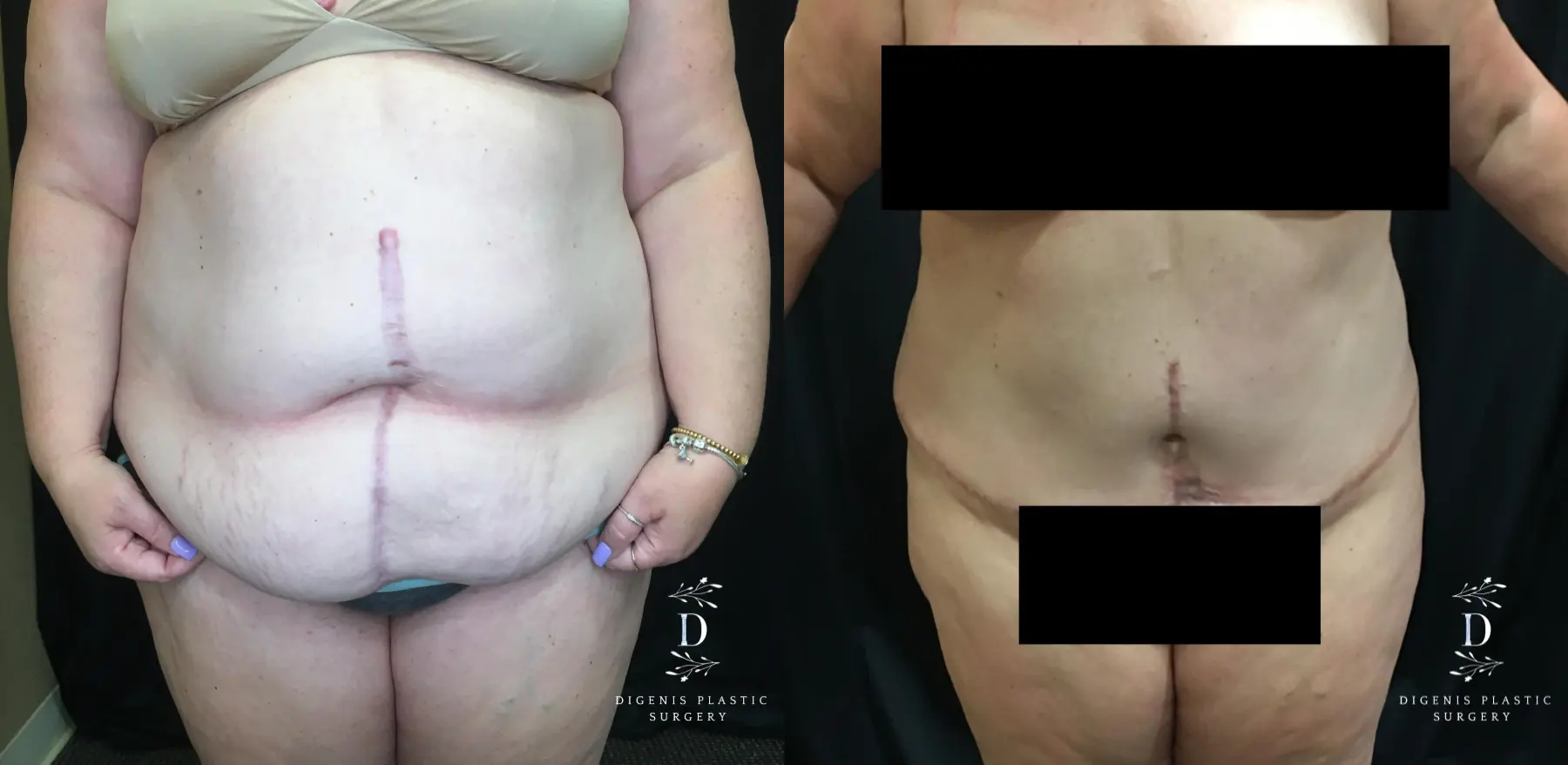 Abdominoplasty: Patient 14 - Before and After 1