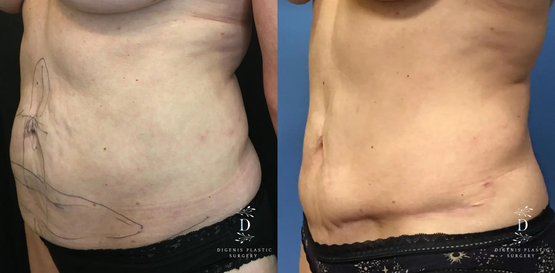 Abdominoplasty: Patient 16 - Before and After 4
