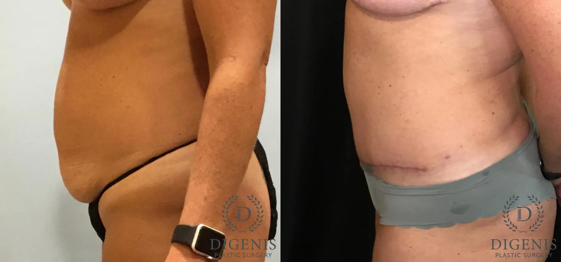 Abdominoplasty: Patient 4 - Before and After 5