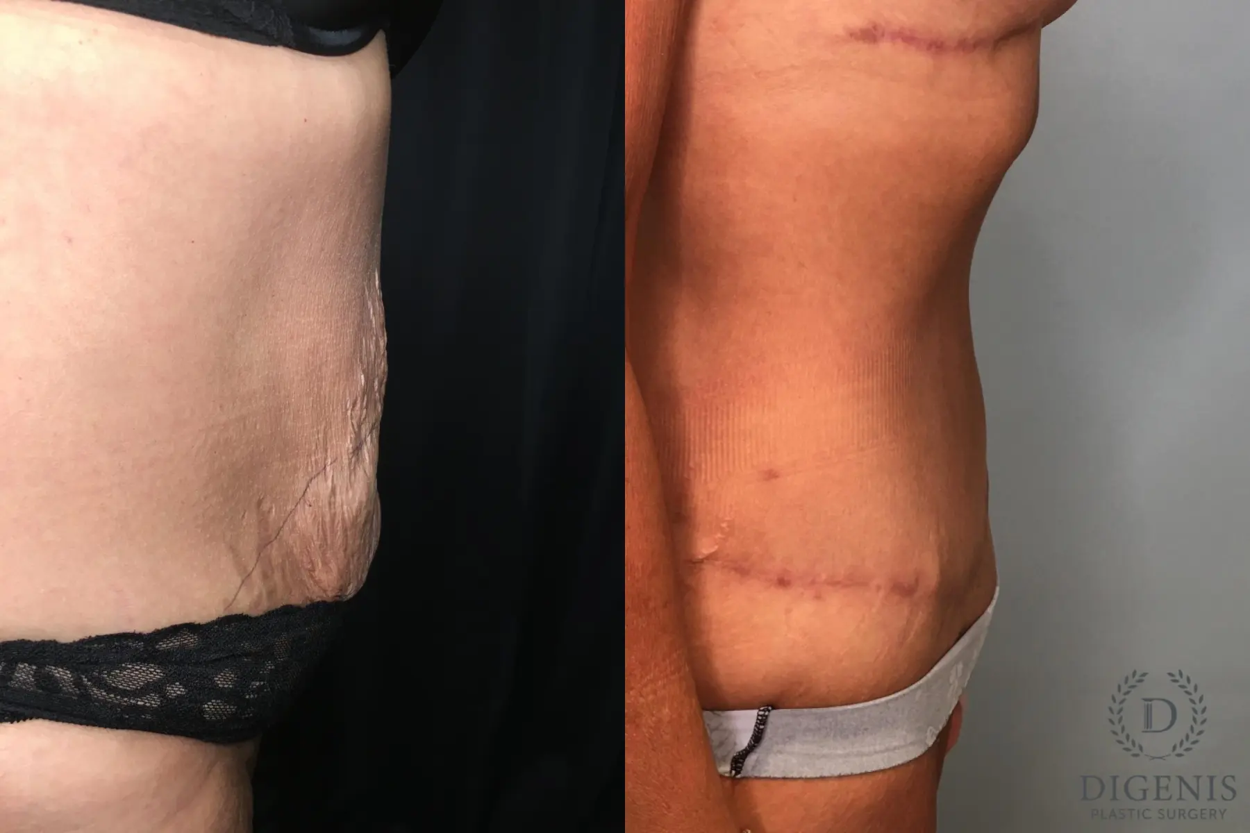 Abdominoplasty: Patient 20 - Before and After 5