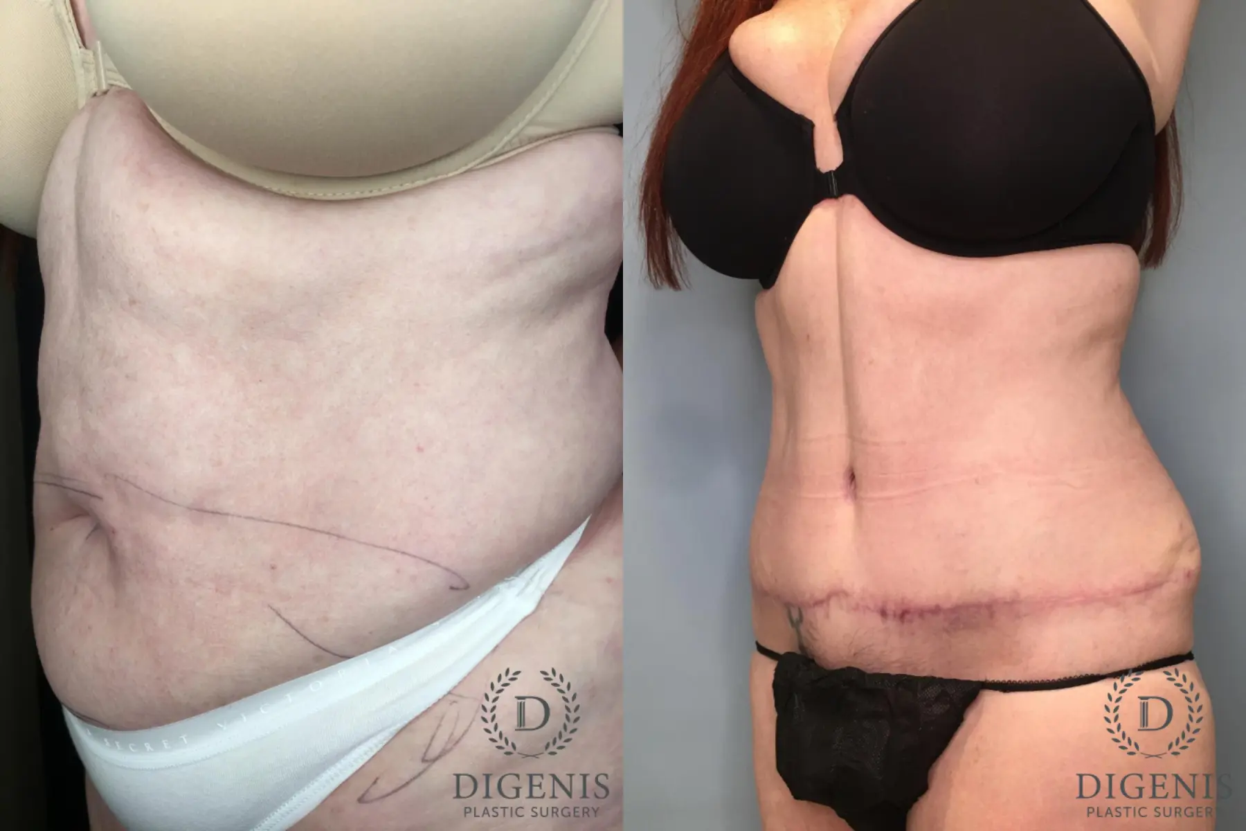 Abdominoplasty: Patient 22 - Before and After 2
