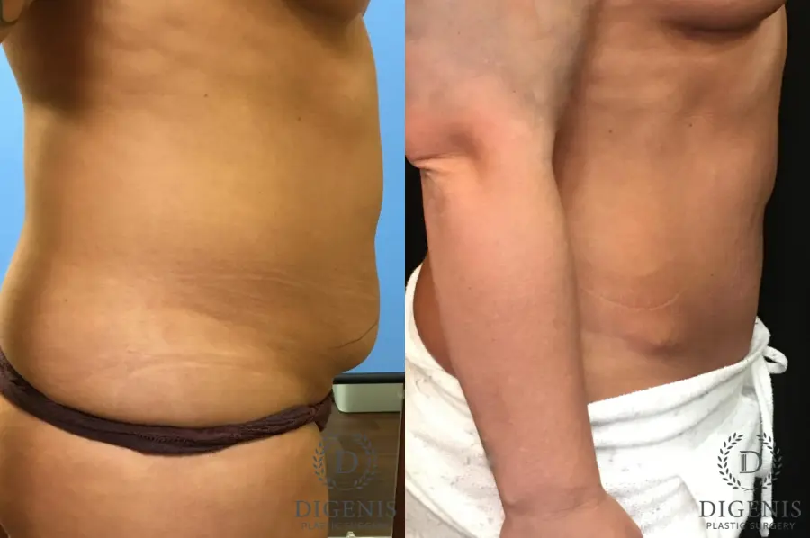 Abdominoplasty: Patient 2 - Before and After 3