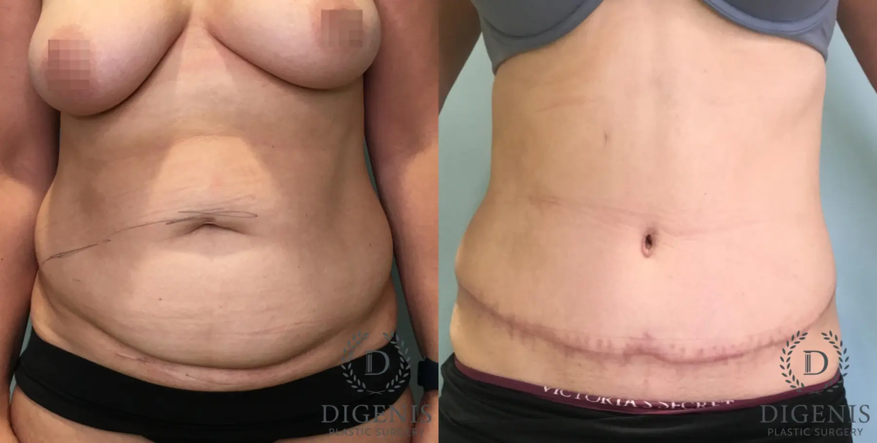 Abdominoplasty: Patient 28 - Before and After  