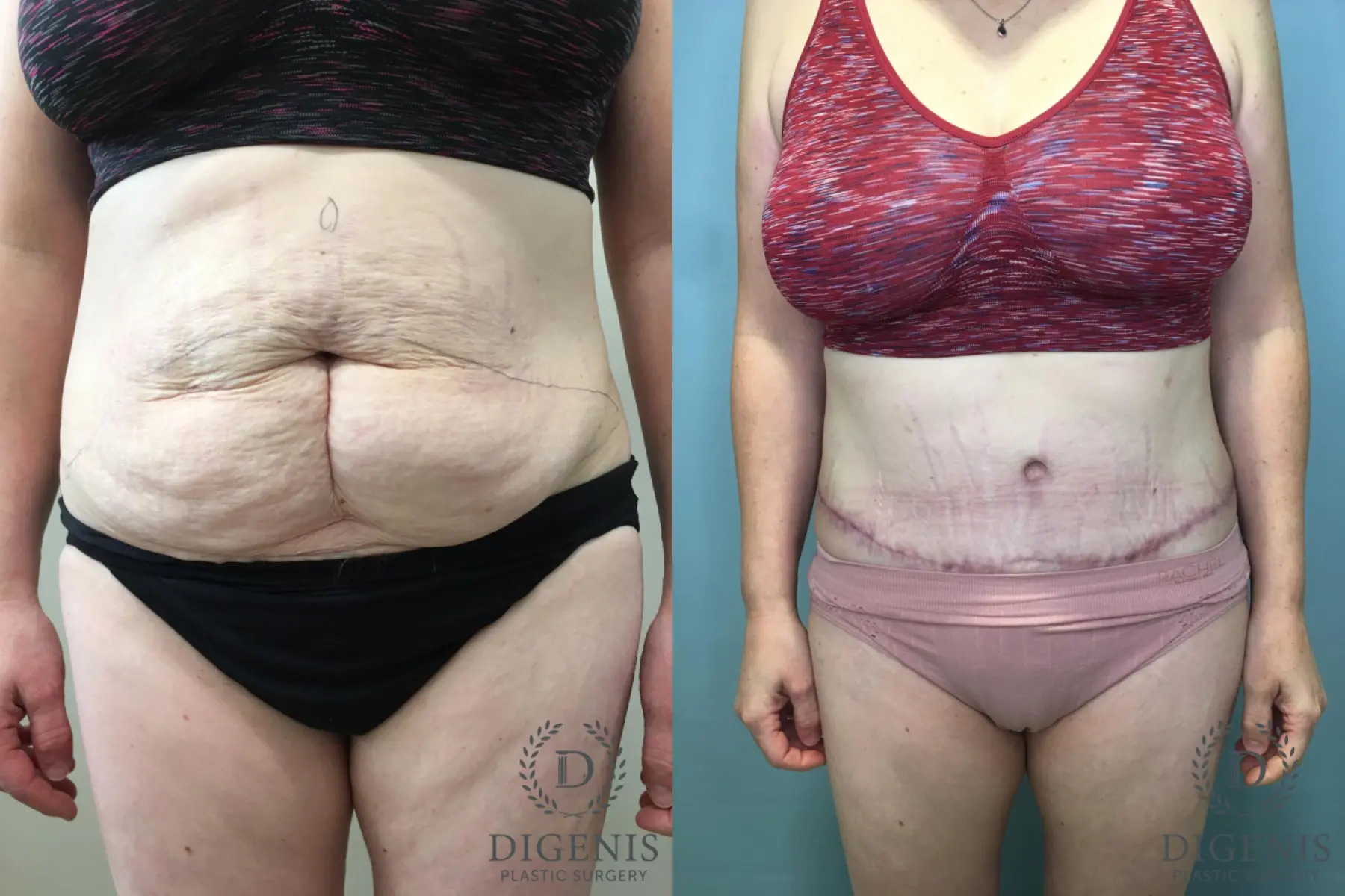 Abdominoplasty: Patient 22 - Before and After  