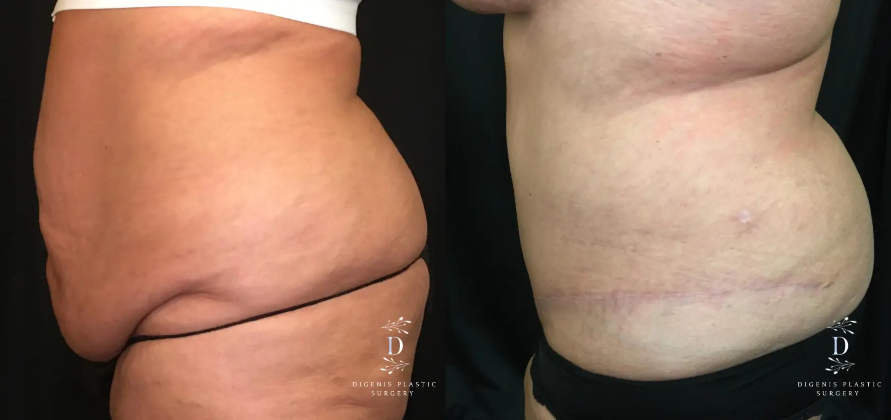 Abdominoplasty: Patient 8 - Before and After 4