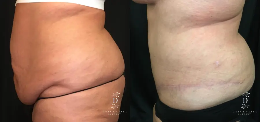 Abdominoplasty: Patient 7 - Before and After 4