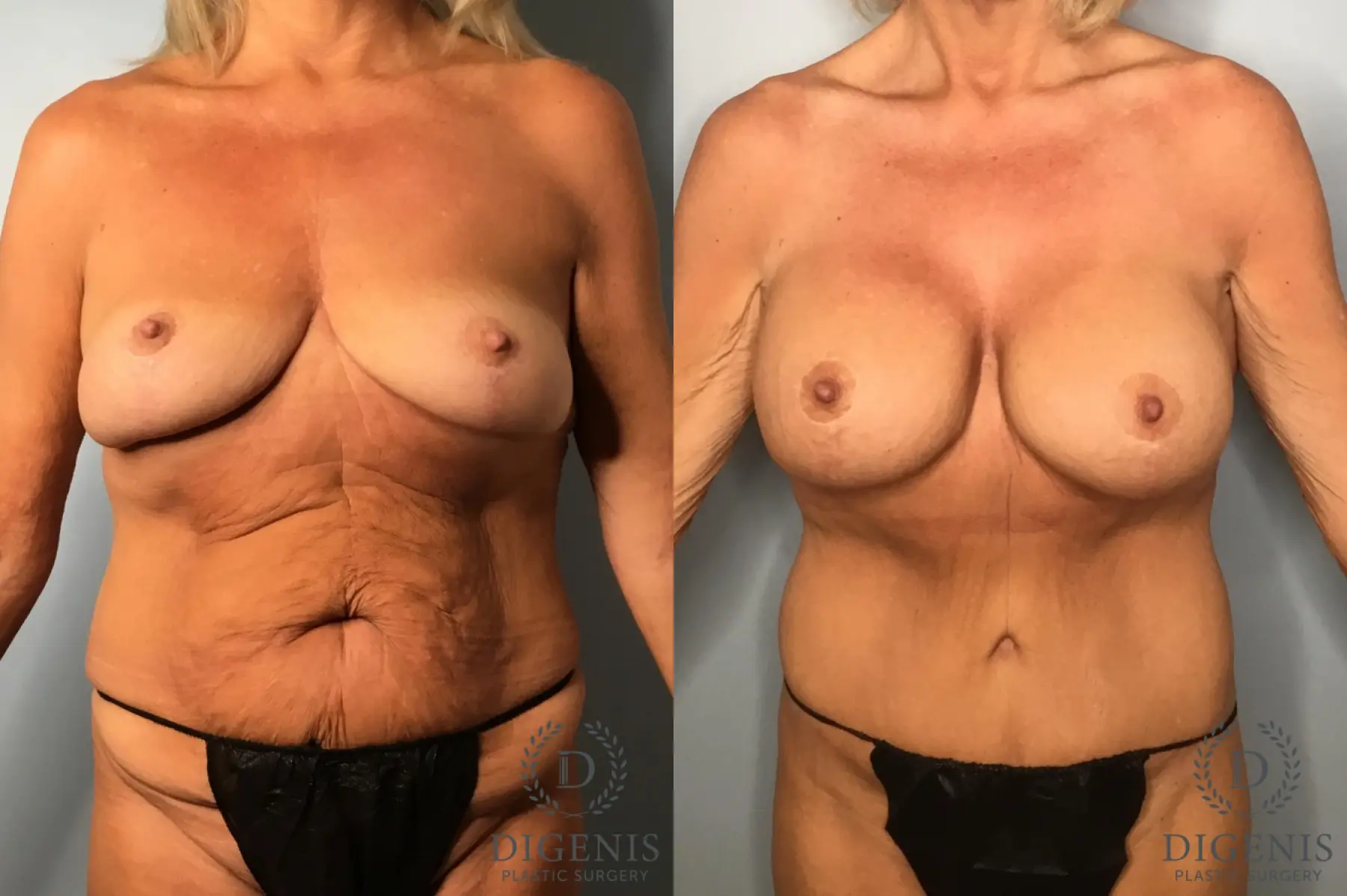 Abdominoplasty: Patient 29 - Before and After  