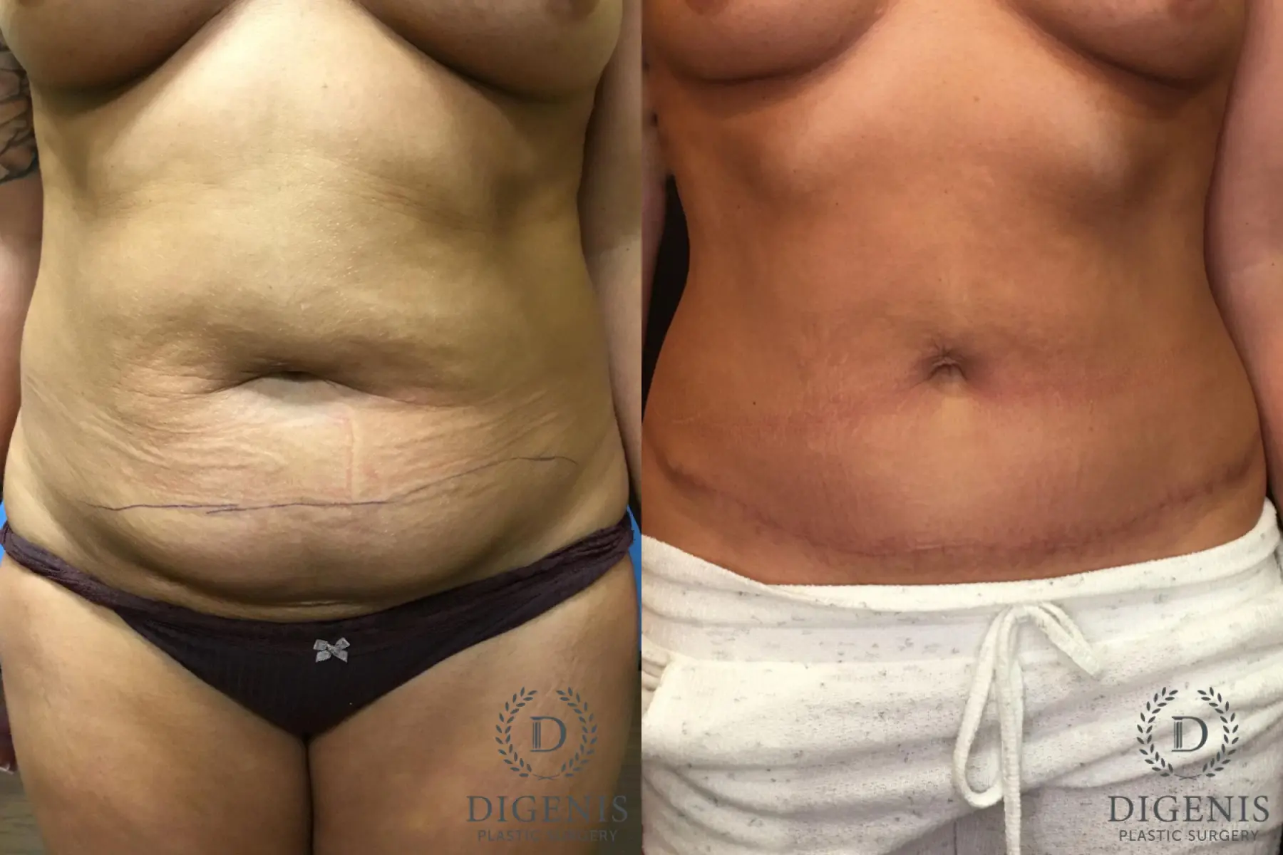 Abdominoplasty: Patient 2 - Before and After  