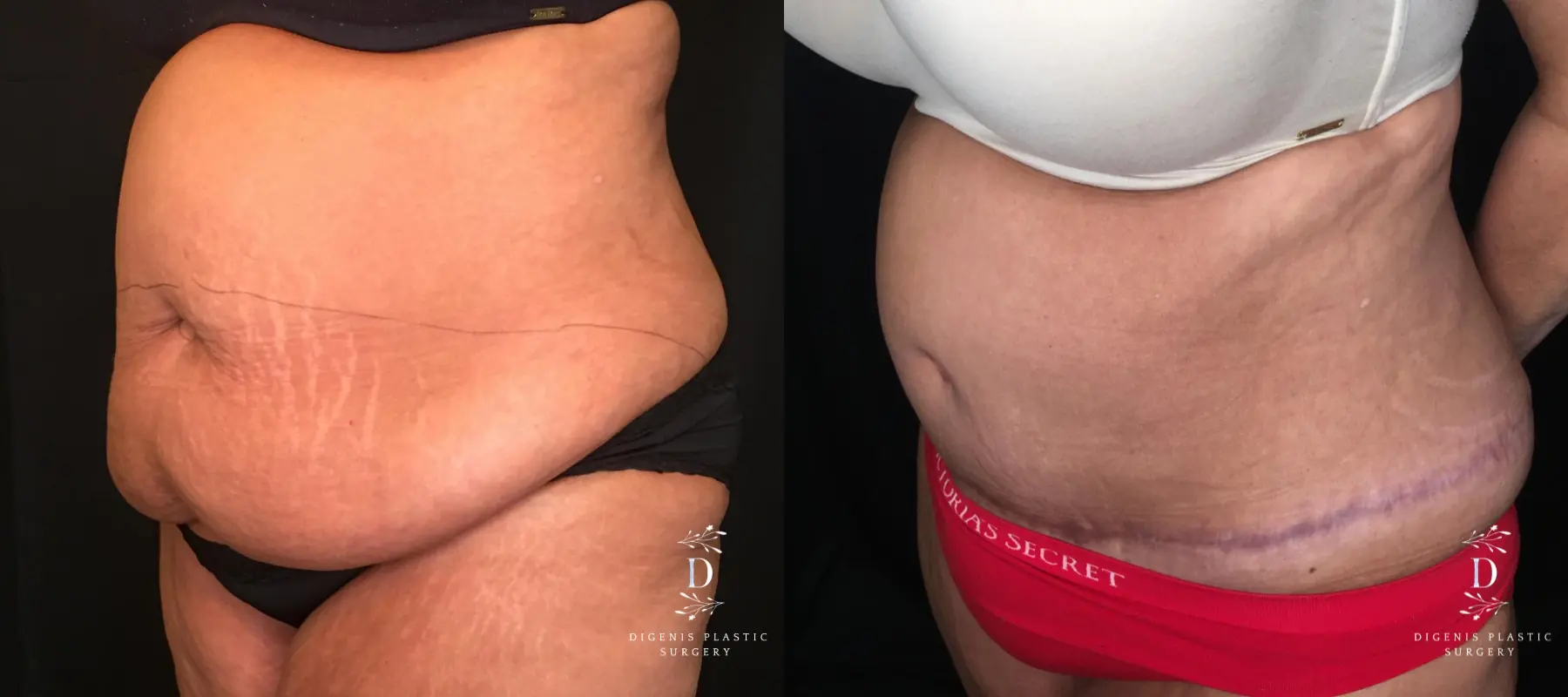 Abdominoplasty: Patient 13 - Before and After 4