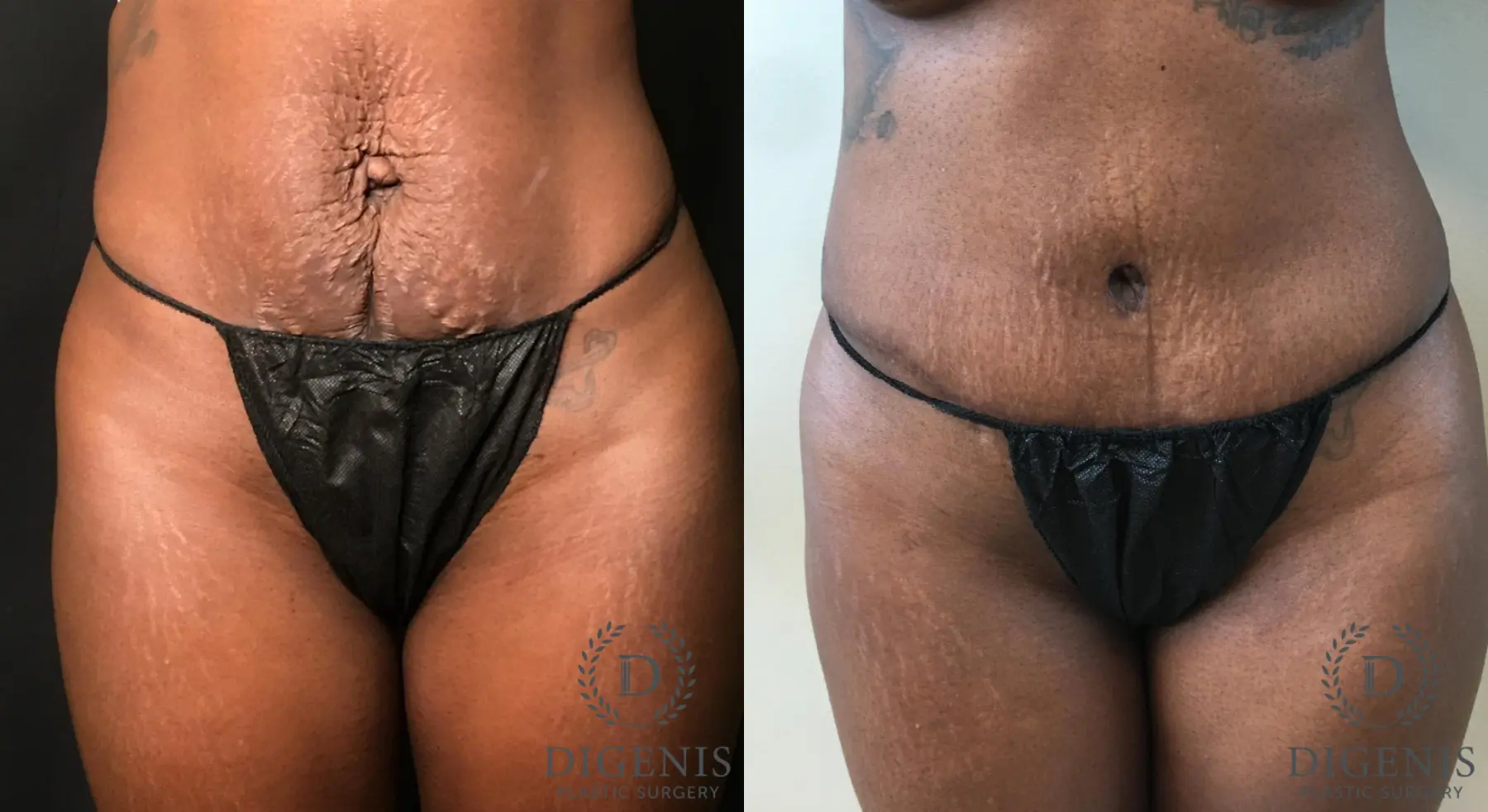 Abdominoplasty: Patient 18 - Before and After 1