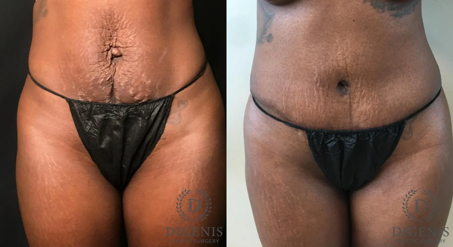 Abdominoplasty: Patient 19 - Before and After  