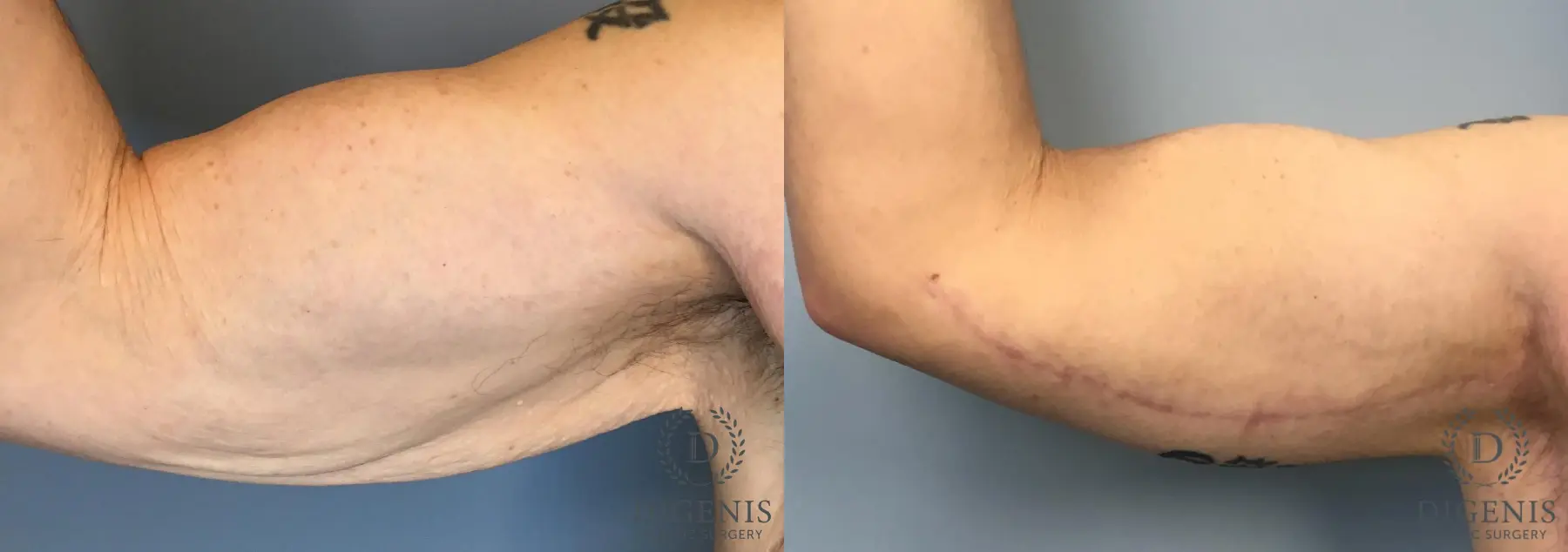 Arm Lift: Patient 2 - Before and After 2