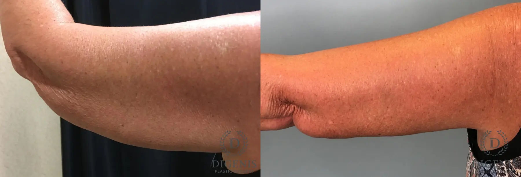 Arm Lift: Patient 3 - Before and After 4