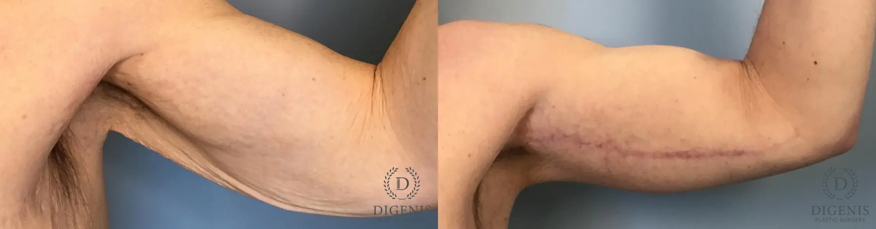 Arm Lift: Patient 2 - Before and After  