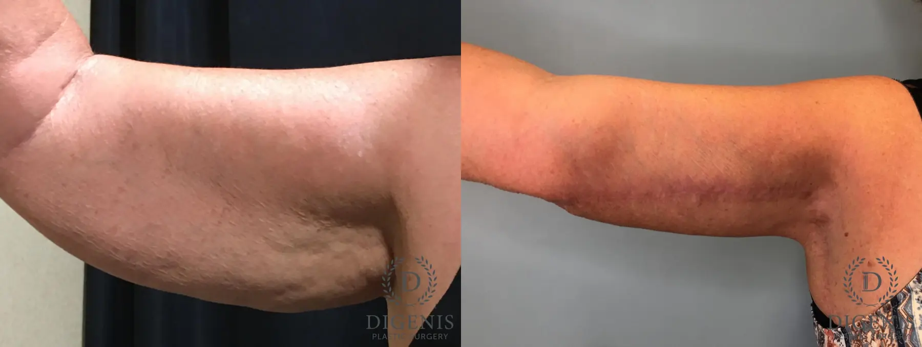 Arm Lift: Patient 3 - Before and After 3