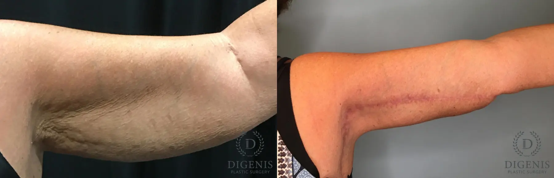 Arm Lift: Patient 3 - Before and After  