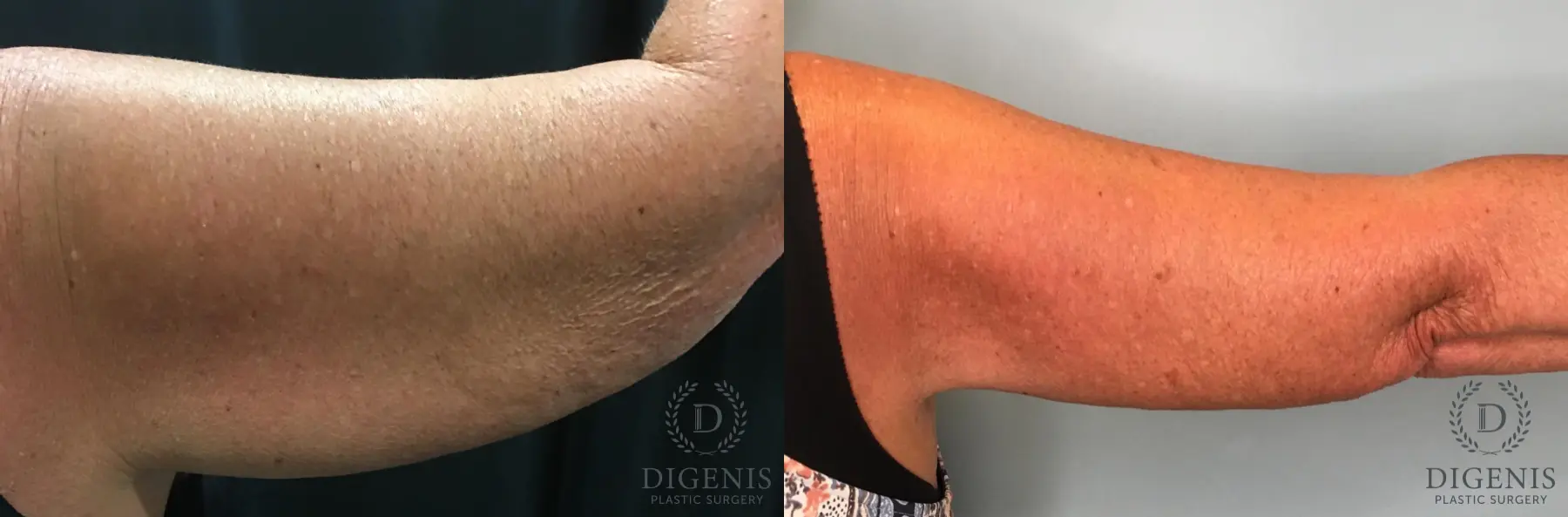 Arm Lift: Patient 3 - Before and After 2