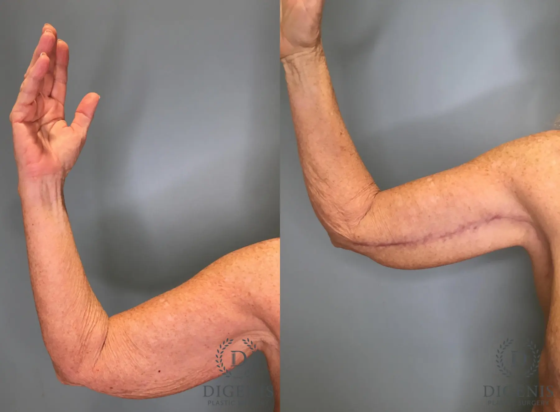 Arm Lift: Patient 1 - Before and After  