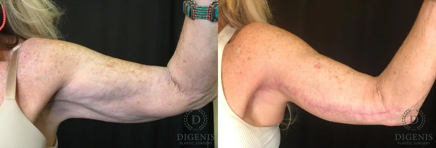 Arm Lift: Patient 2 - Before and After  