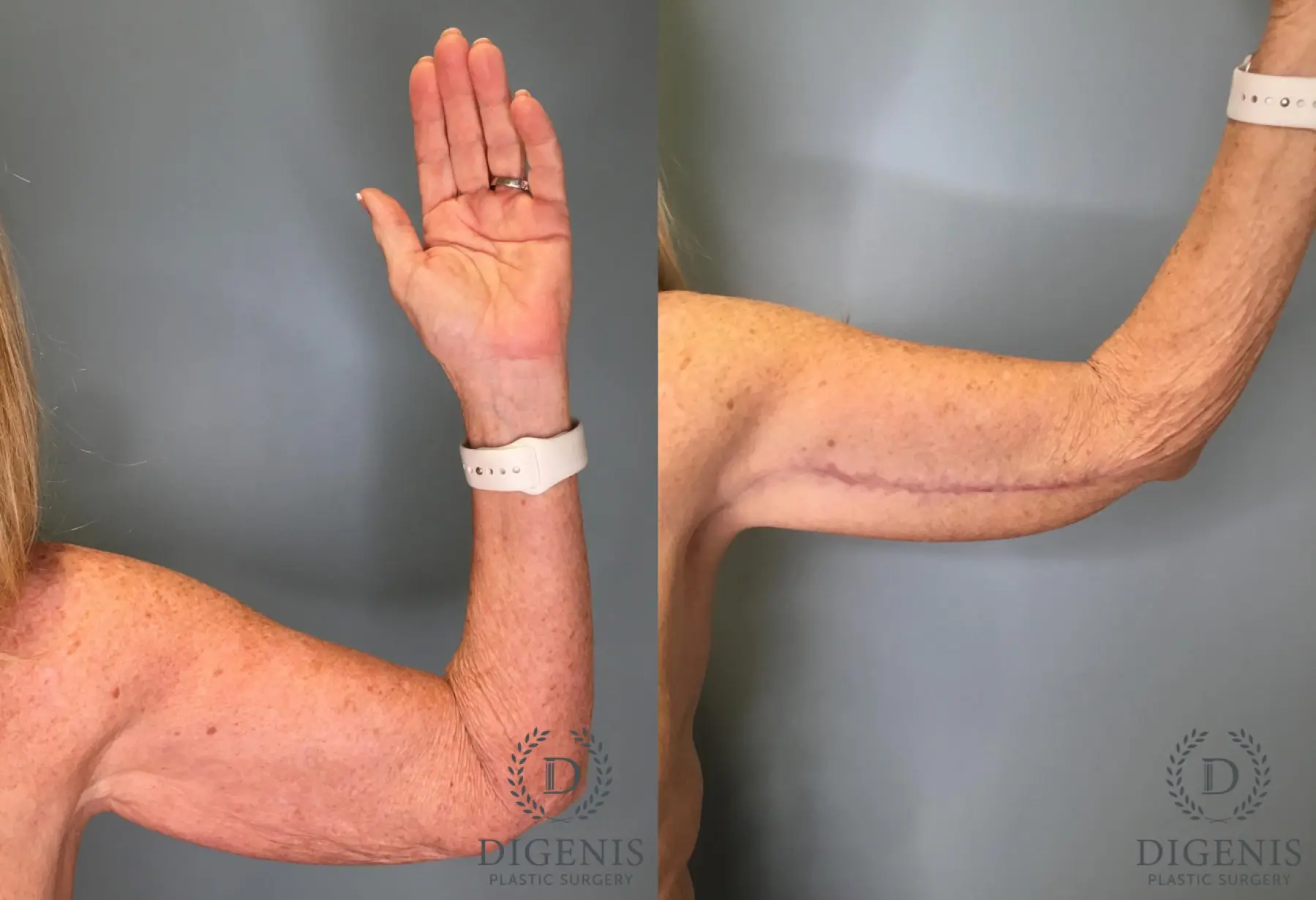 Arm Lift: Patient 1 - Before and After 2