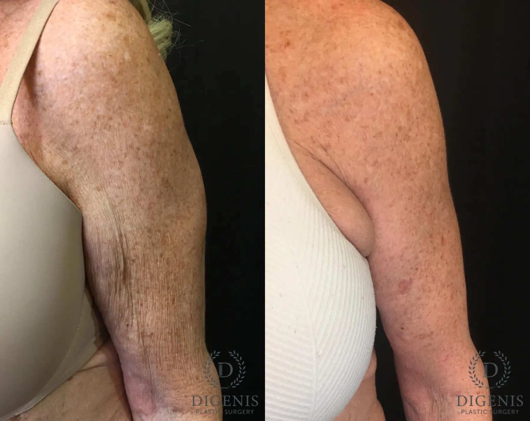 Arm Lift: Patient 2 - Before and After 4