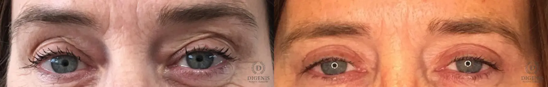 Blepharoplasty: Patient 14 - Before and After 1