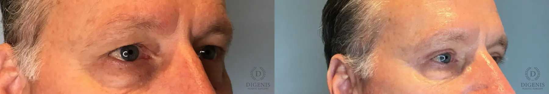 Blepharoplasty: Patient 2 - Before and After 2