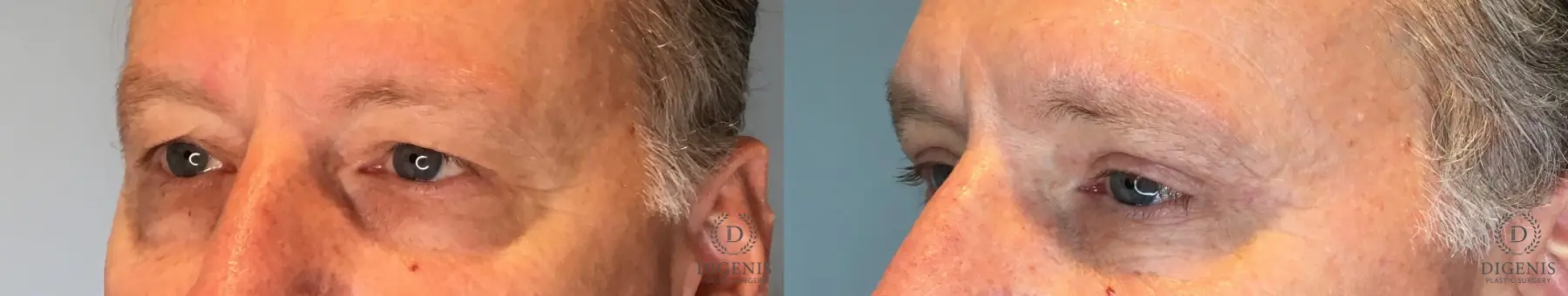 Blepharoplasty: Patient 2 - Before and After 4