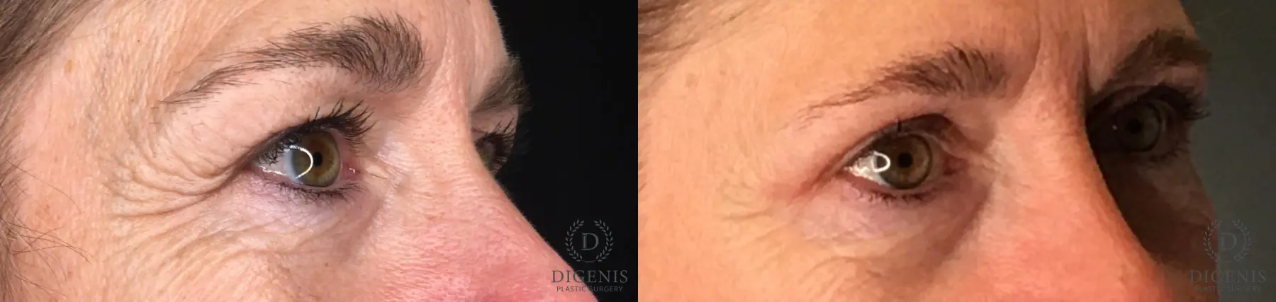 Blepharoplasty: Patient 6 - Before and After 4