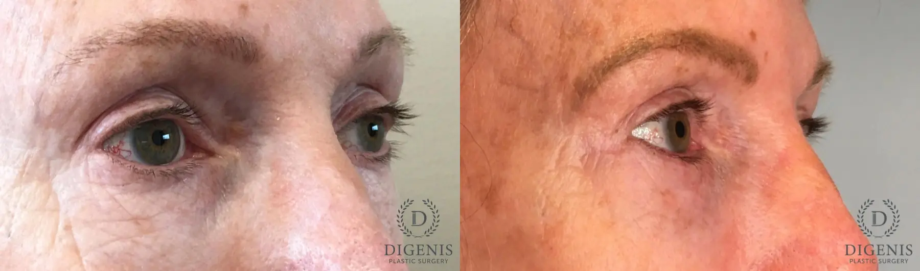 Blepharoplasty: Patient 13 - Before and After 2