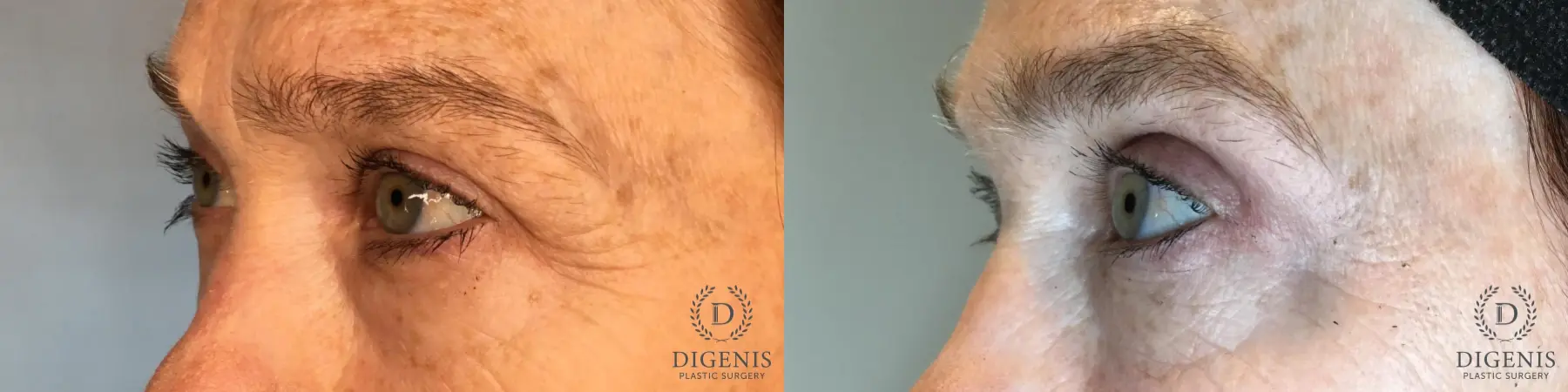 Blepharoplasty: Patient 1 - Before and After 2