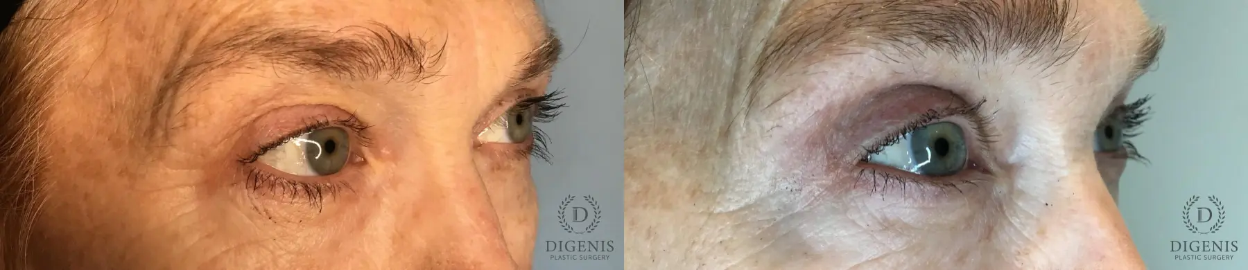 Blepharoplasty: Patient 1 - Before and After 5
