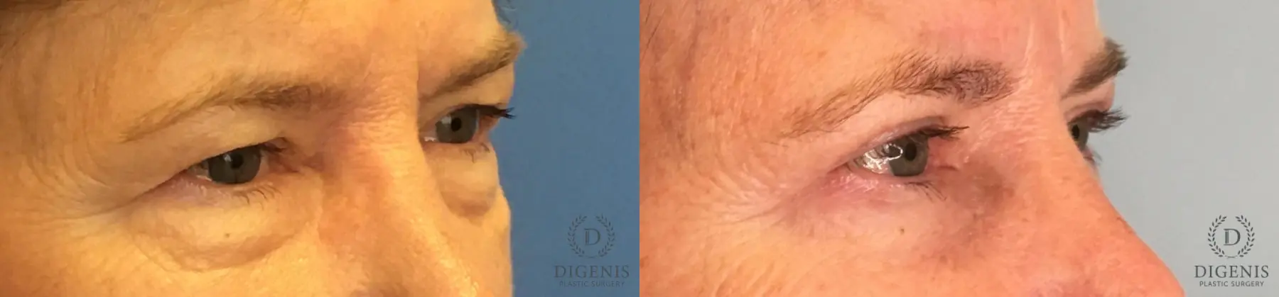 Blepharoplasty: Patient 12 - Before and After 2