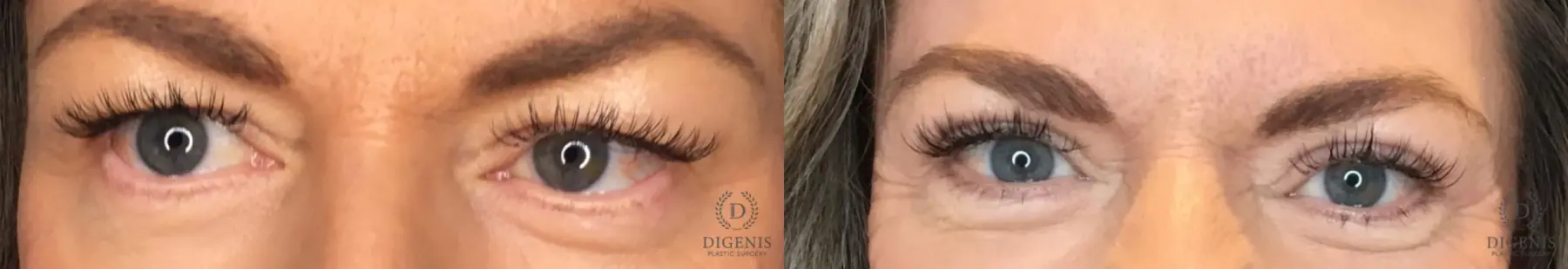 Blepharoplasty: Patient 1 - Before and After  