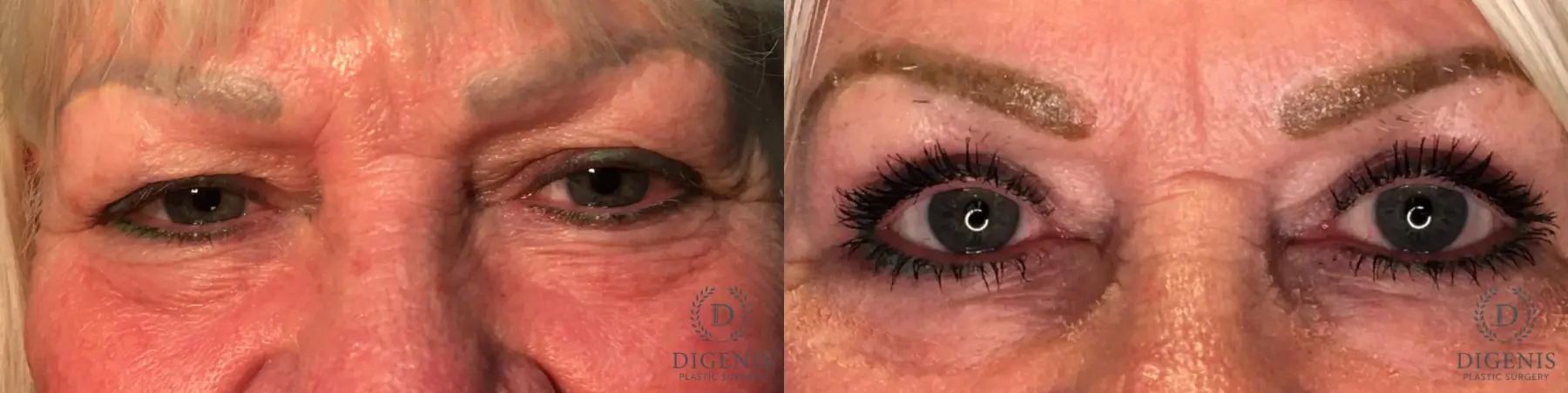 Blepharoplasty: Patient 3 - Before and After  