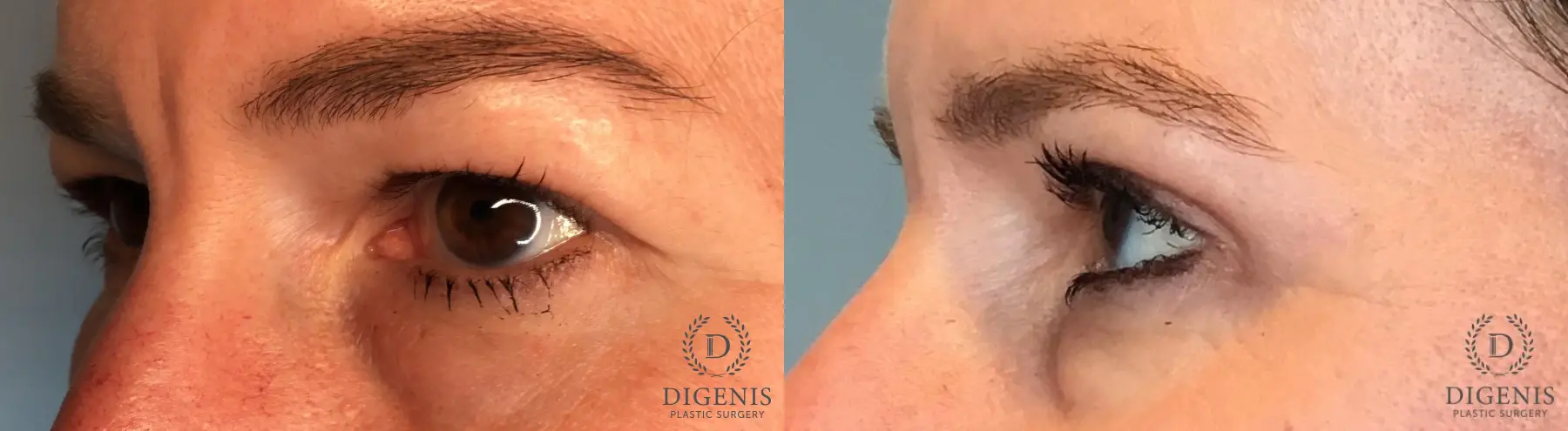 Blepharoplasty: Patient 1 - Before and After 2